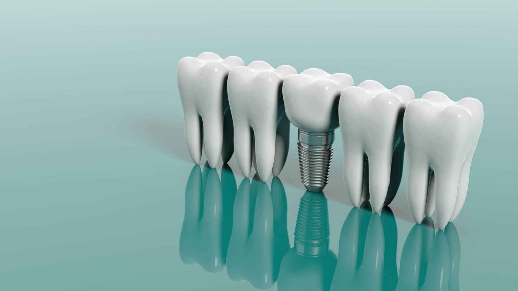 Dental Implants