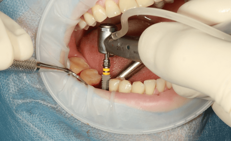 A Guide to Dental Implants Procedure