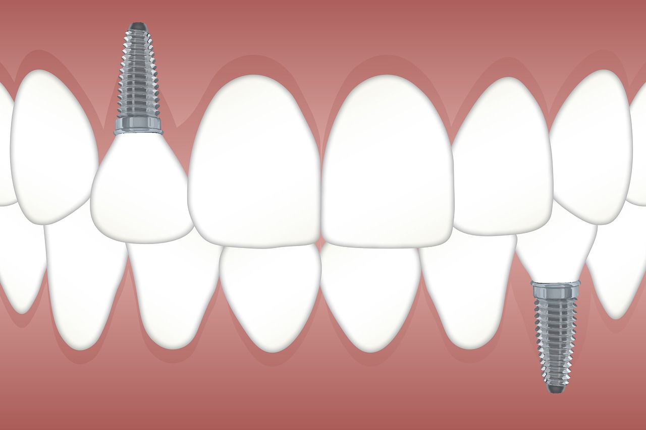 FAQs on Dental Implants!