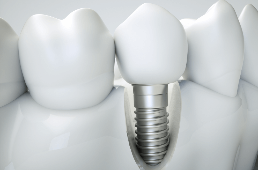 Dental Implants