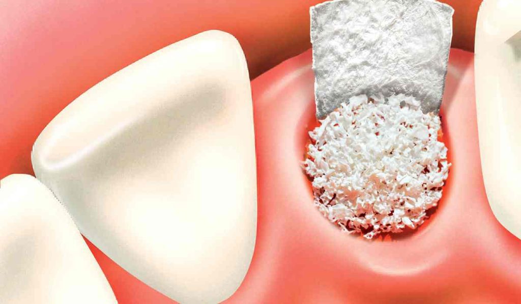 Tooth implant in Melbourne