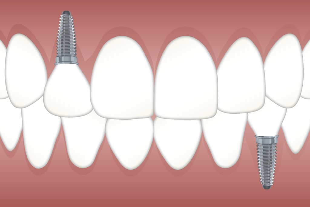 Tooth implant Melbourne