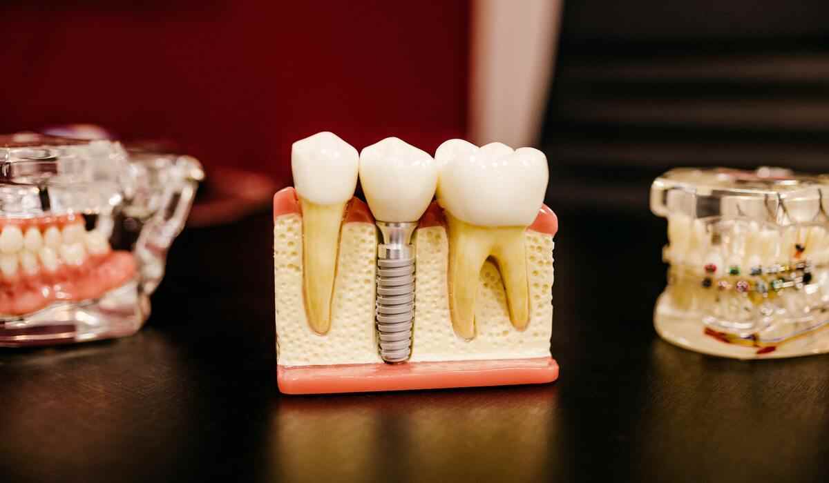 dental implants Melbourne cost