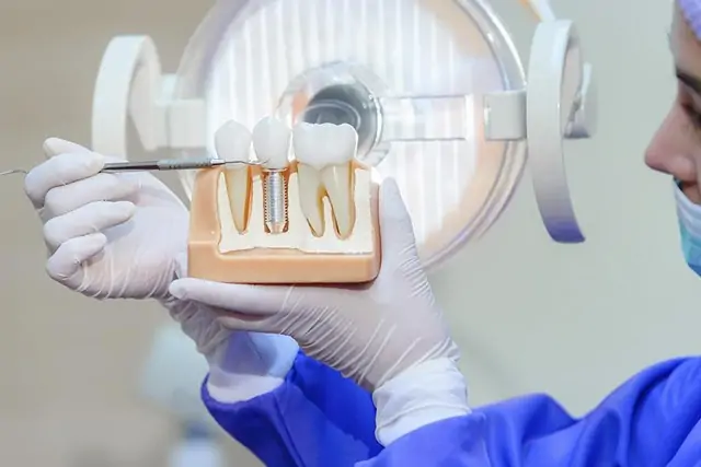 Tooth Replacement - dental implant professionals - melbourne