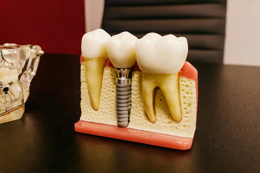 Smoking and dental implants – tips to reduce dental implant failure risk