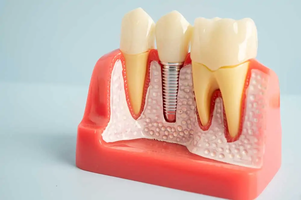 Dental Implant model to replace the missed teeth.