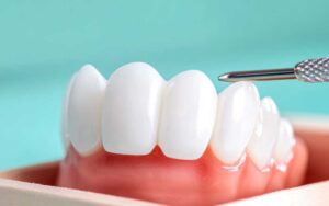 Zirconia Front Tooth Replacement - Dental procedure on teeth