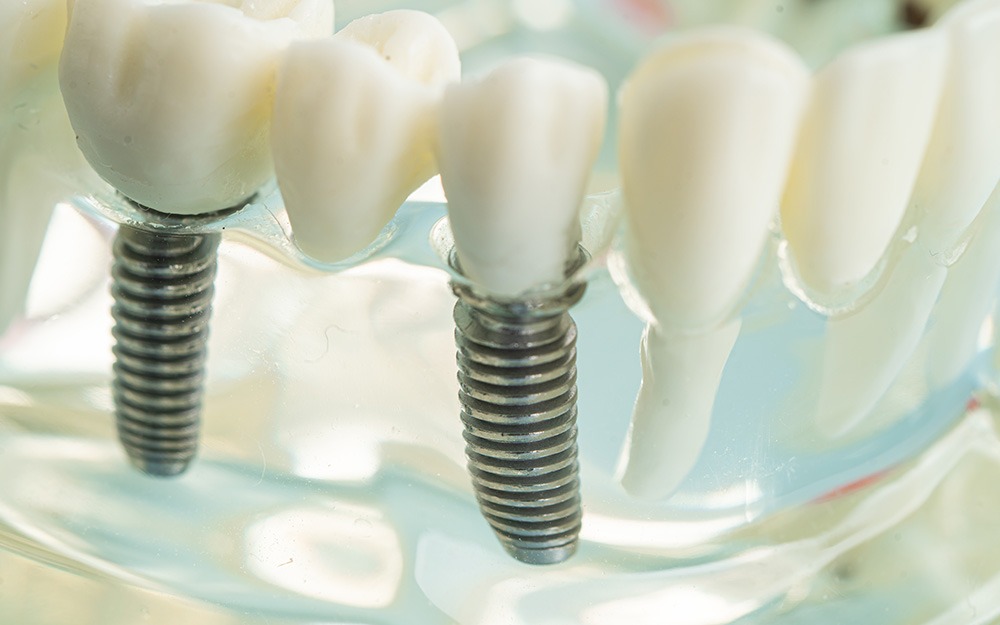 All-on-4 vs traditional dentures comparison showing benefits stability comfort and long term results